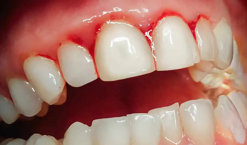 Gengiva avermelhada precisando de limpeza nos dentes - Allegra Odontologia