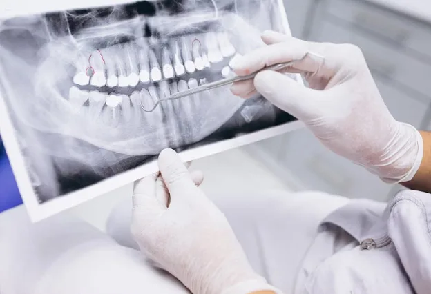 Implantes Dentários: Como Funcionam E Para Quem São Indicados