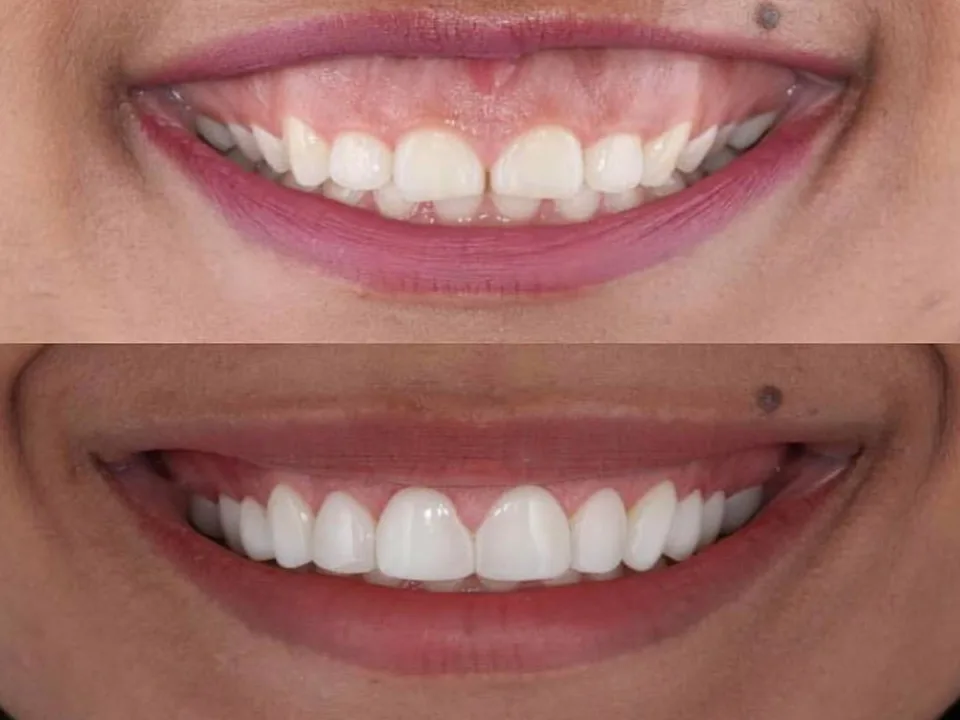Gengivoplastia + Lentes de porcelana na Allegra Odontologia - Estética dental