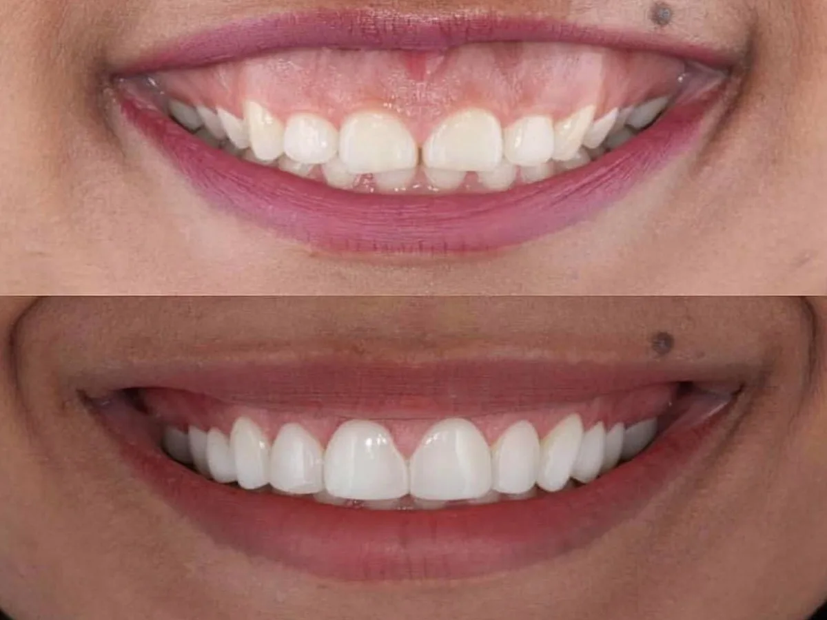 Estética Dental perto de Guarulhos - Allegra Odontologia