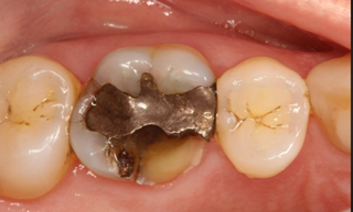Dente quebrado e fraturado - Allegra Odontologia