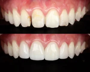 Lentes dentais de porcelana na Allegra Odontologia