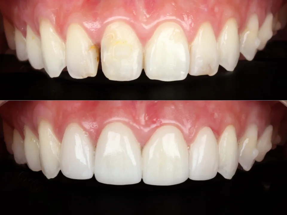 Lentes dentais de porcelana na Allegra Odontologia