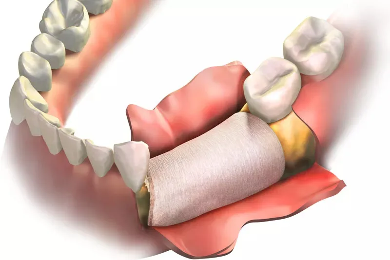 Imagem ilustrartiva de um enxerto osseo autógeno - Allegra Odontologia