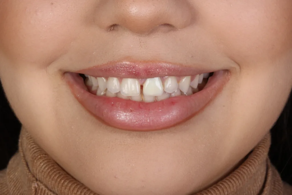 Paciente com Gap entre os dentes na Allegra Odontologia