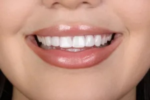 Paciente que fechou o Gap com as Facetas de porcelana na Allegra Odontologia