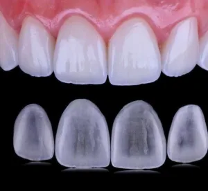 Lentes de porcelana com o Dr. Rodolfo Segawa - Especialista em próteses dentárias - Allegra Odontologia