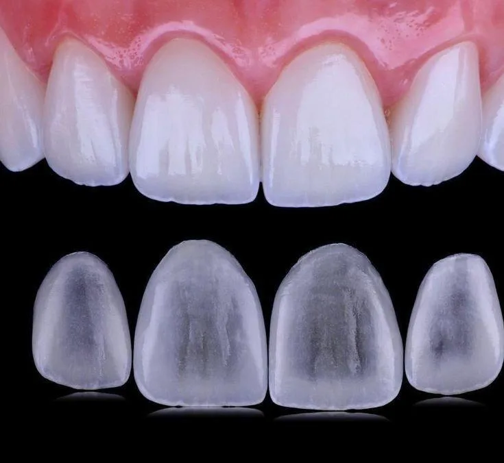 Lentes de porcelana com o Dr. Rodolfo Segawa - Especialista em próteses dentárias - Allegra Odontologia