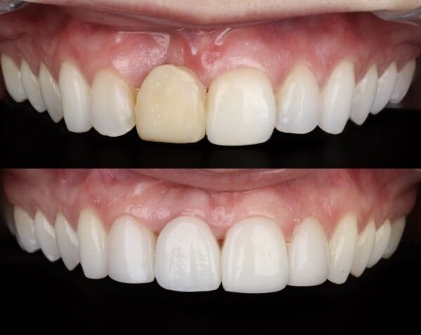Implante Na Zona Leste - Allegra Odontologia