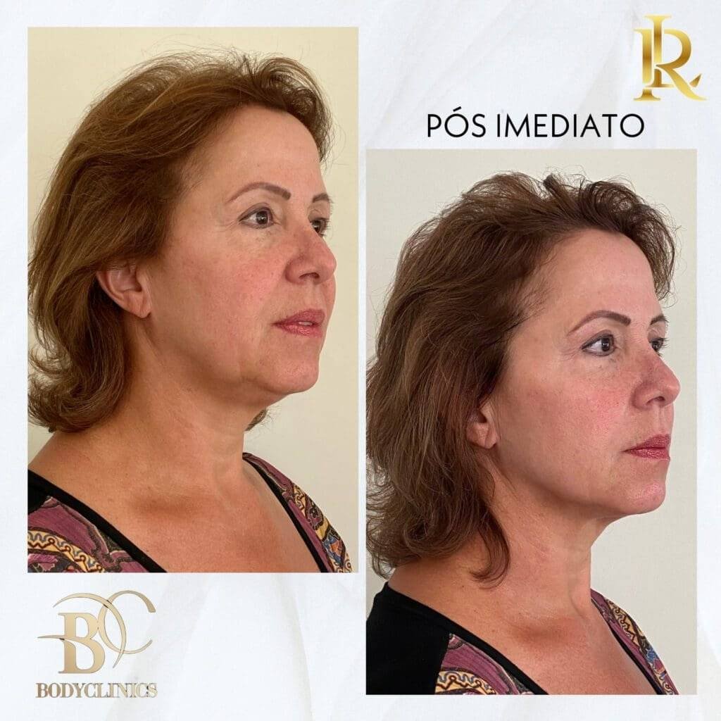 Harmonização Facial perto do Alto da Mooca - Allegra Odontologia