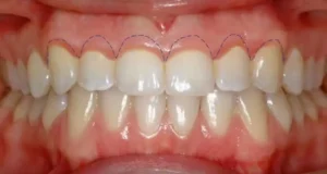 Gengivoplastia na Allegra Odontologia