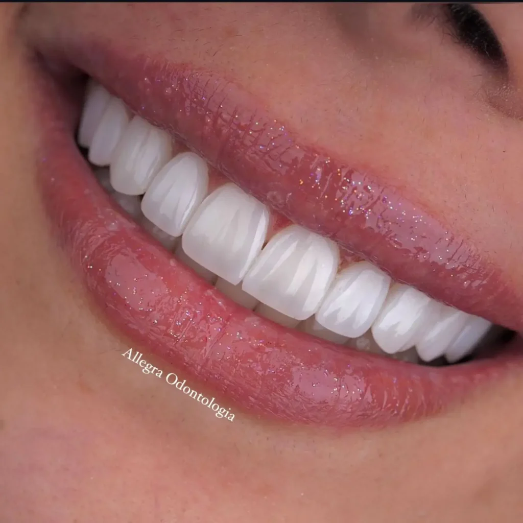 Lentes de porcelana na Allegra Odontologia