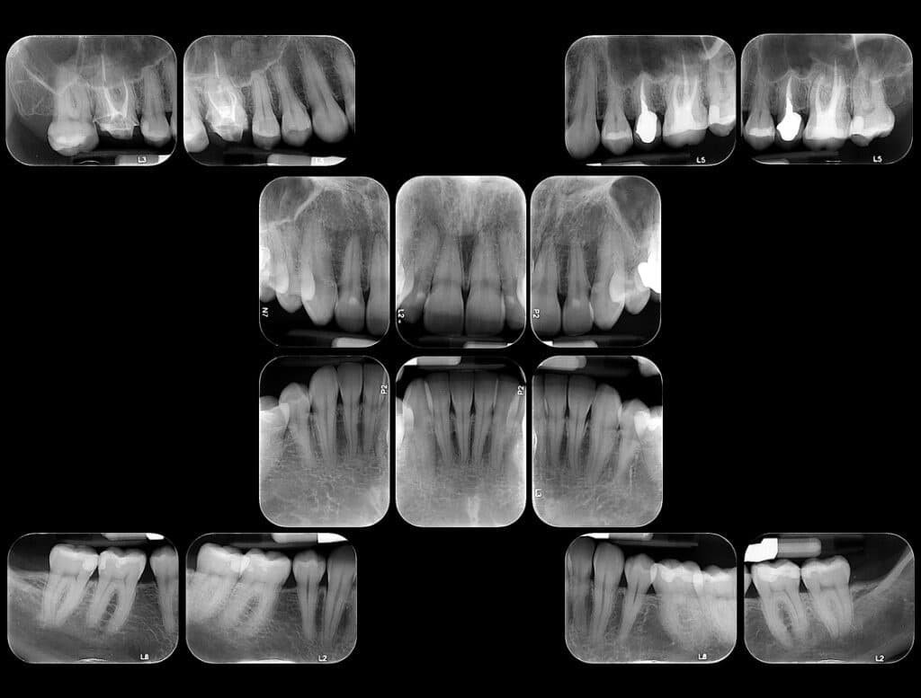 Raio x periapical na Allegra Odontologia