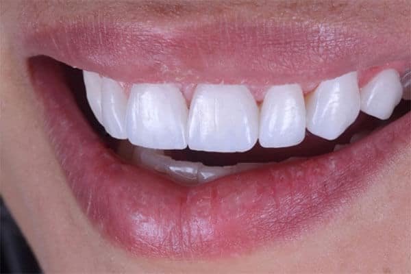 Lentes de porcelana: close-up de um sorriso com dentes alinhados e brancos, mostrando o resultado de um tratamento odontológico de alto padrão.