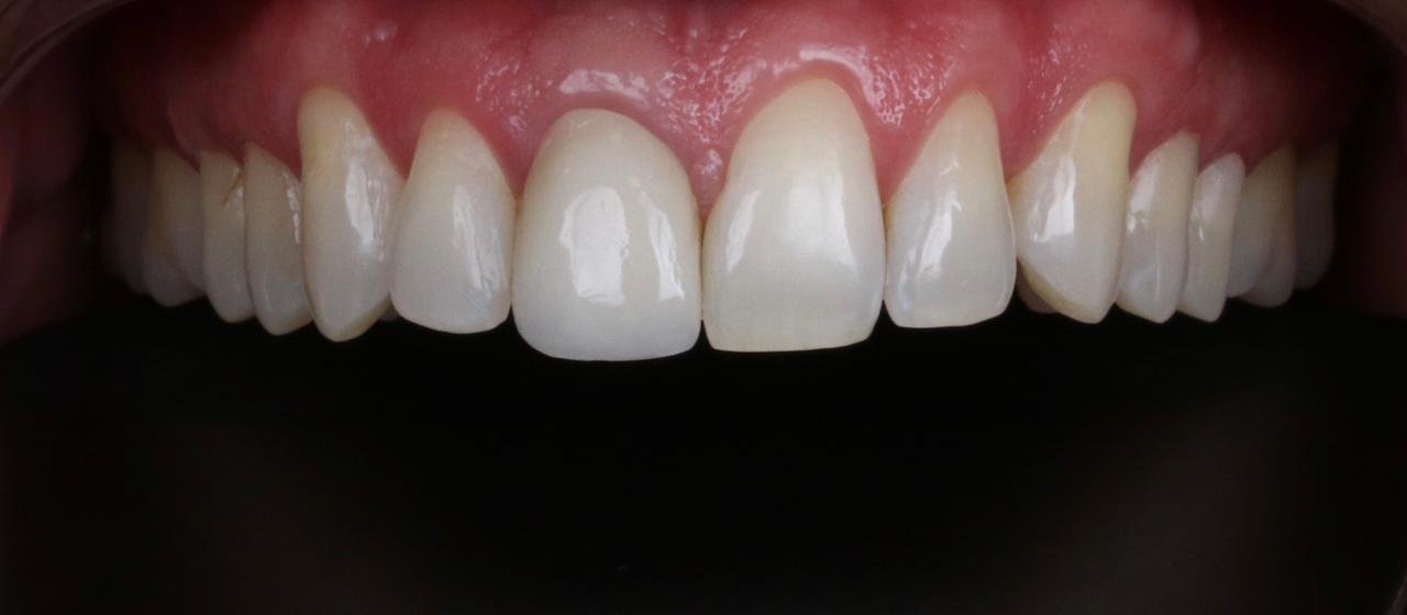 Sorriso perfeito após gengivoplastia premium, evidenciando contorno gengival harmônico.