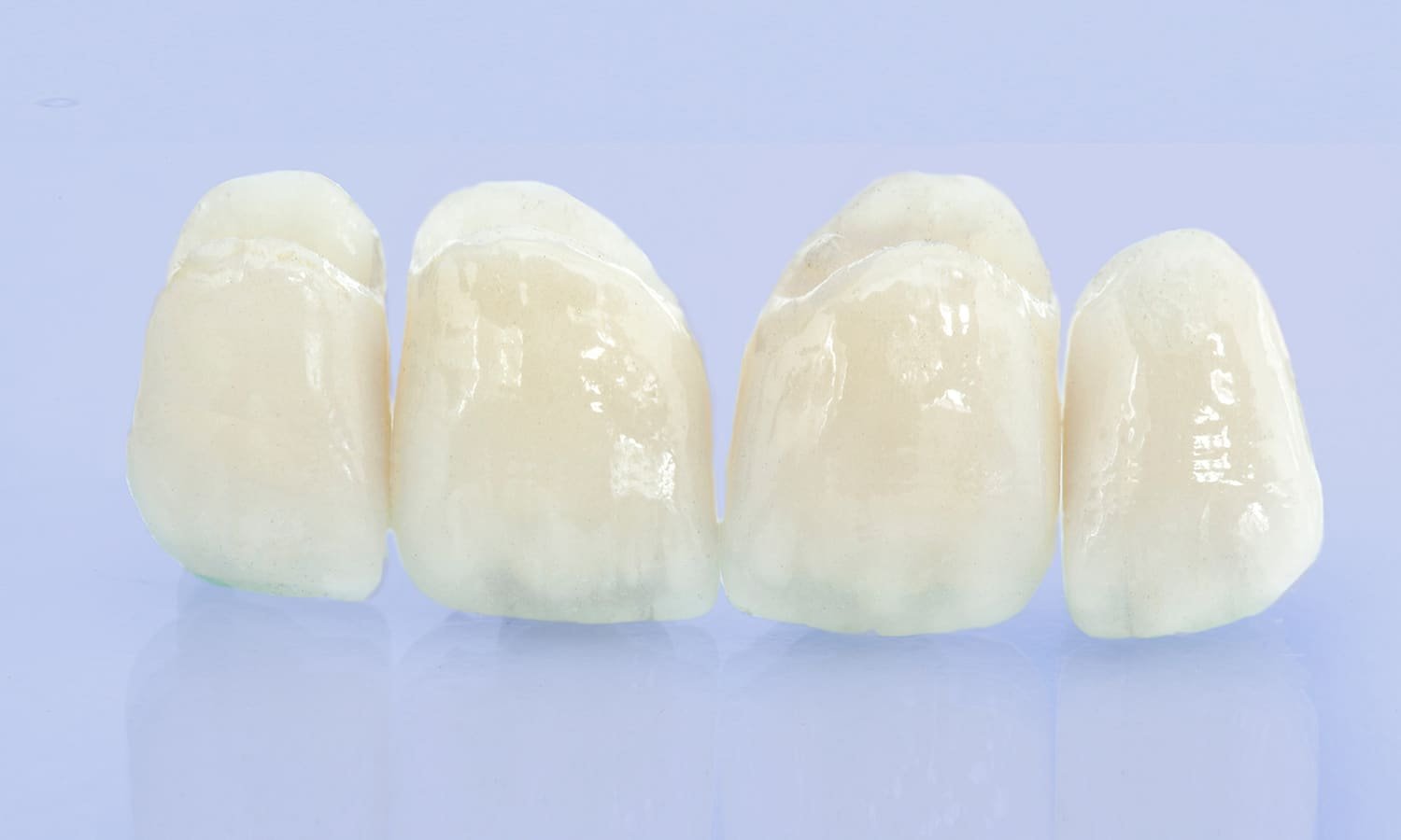 Coroas de porcelana premium altamente resistentes, projetadas para proporcionar estética e funcionalidade superiores na reabilitação oral.