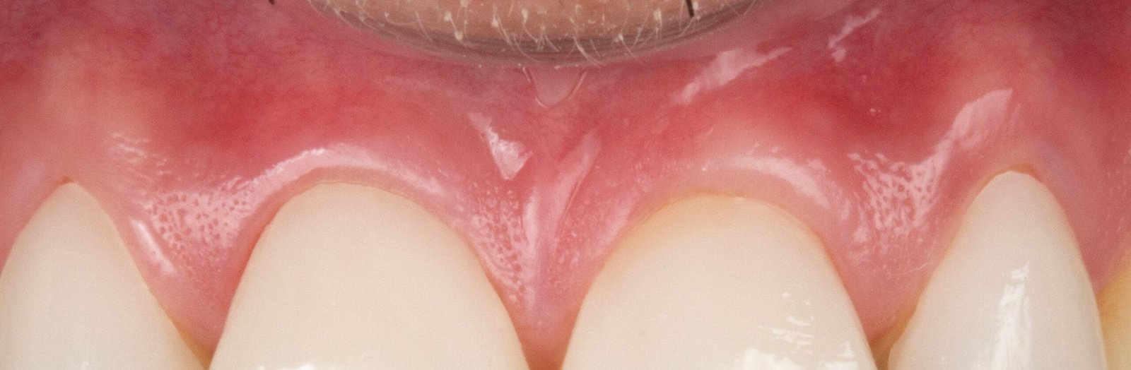 Saúde gengival após tratamento periodontal, evidenciando gengivas saudáveis e estética natural.