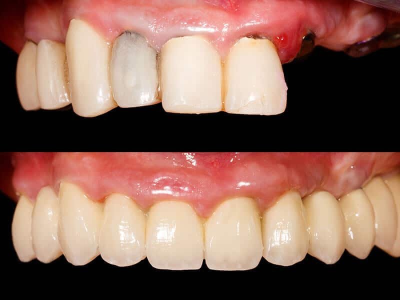 Reabilitação Oral: Transformando sorrisos com próteses dentárias modernas.