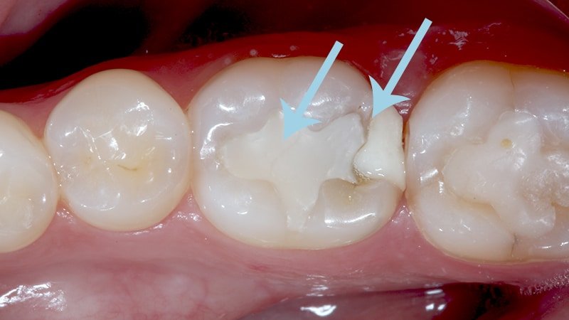 Problemas em restauração dentária com resina, evidenciando falhas na aplicação e desgaste precoce.

