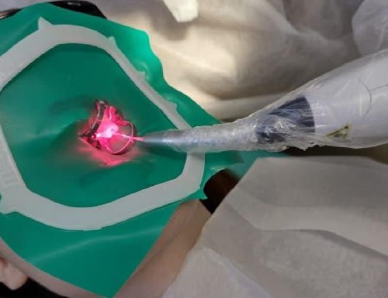 Procedimento endodôntico de alta precisão com uso de laser e isolamento absoluto em tratamento odontológico.