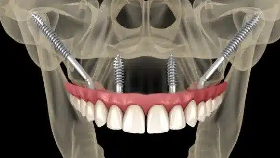 Implantes zigomáticos em reabilitação oral para casos de perda óssea severa.