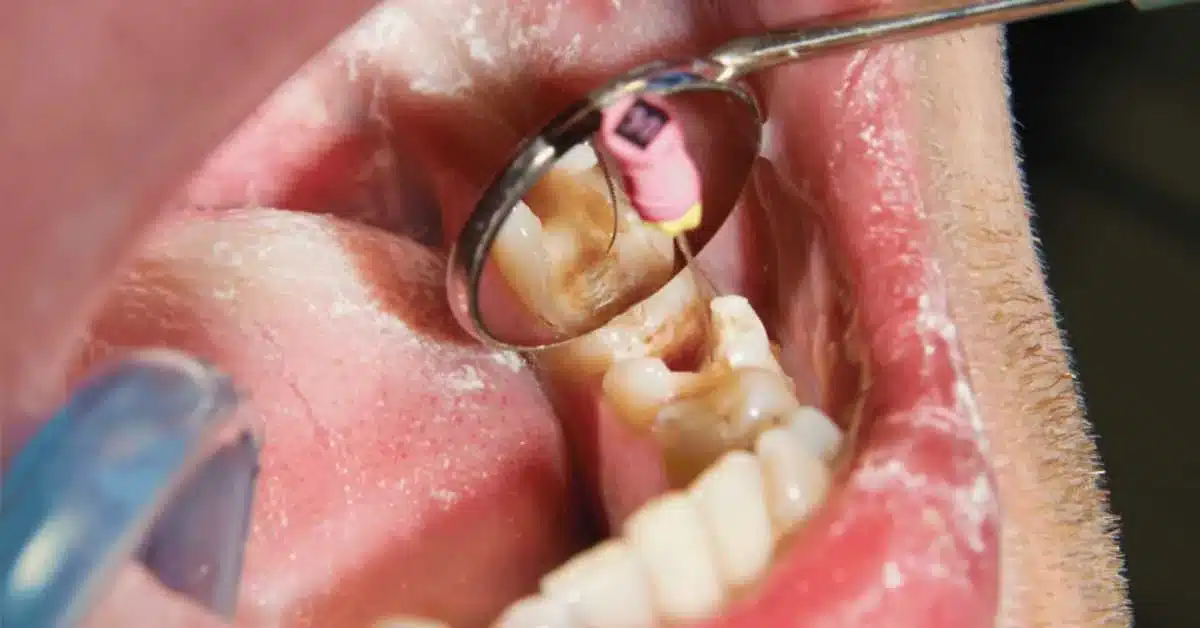 Procedimento de retratamento de canal realizado por endodontista com técnica avançada.