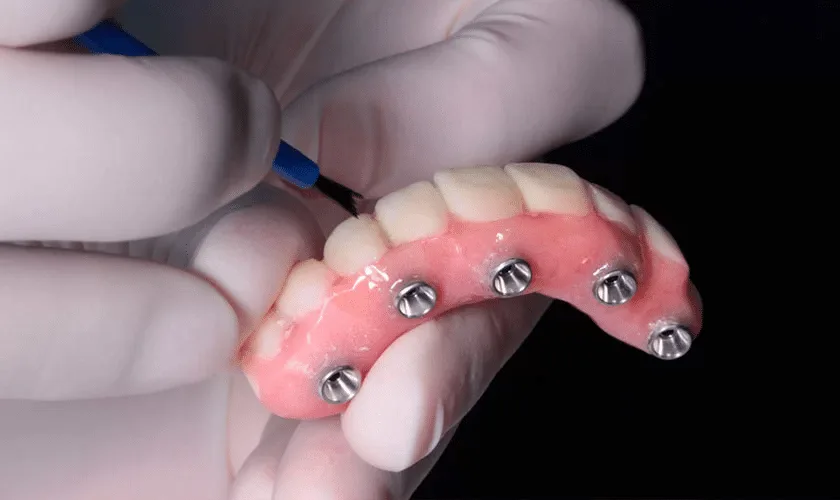 Imagem ilustrativa de um Protocolo Dentário com Carga Imediata mostrando implantes dentários conectados a uma prótese.