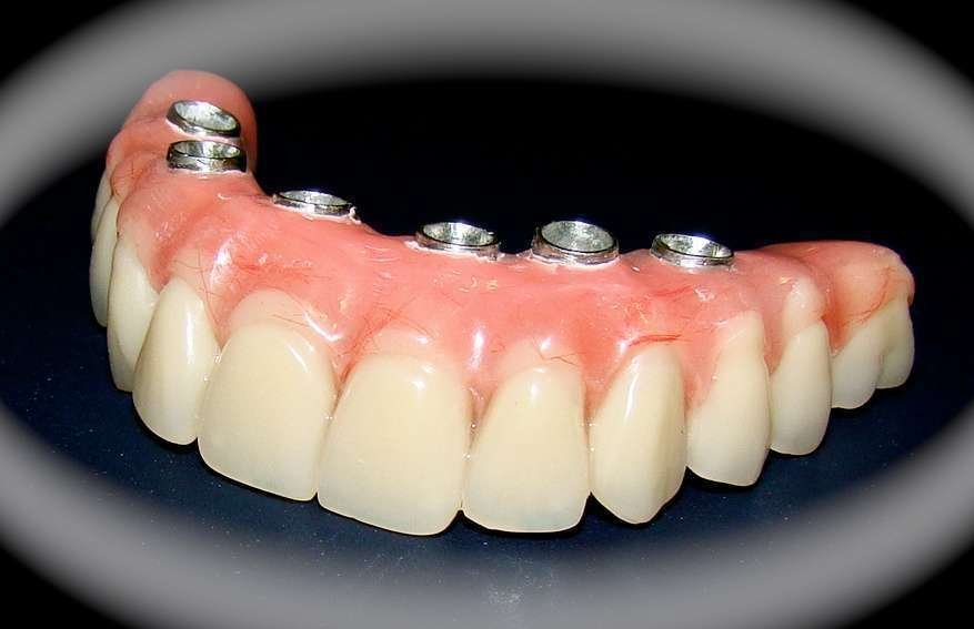 Implante dentário com reabilitação rápida pelo Protocolo Dentário com Carga Imediata.