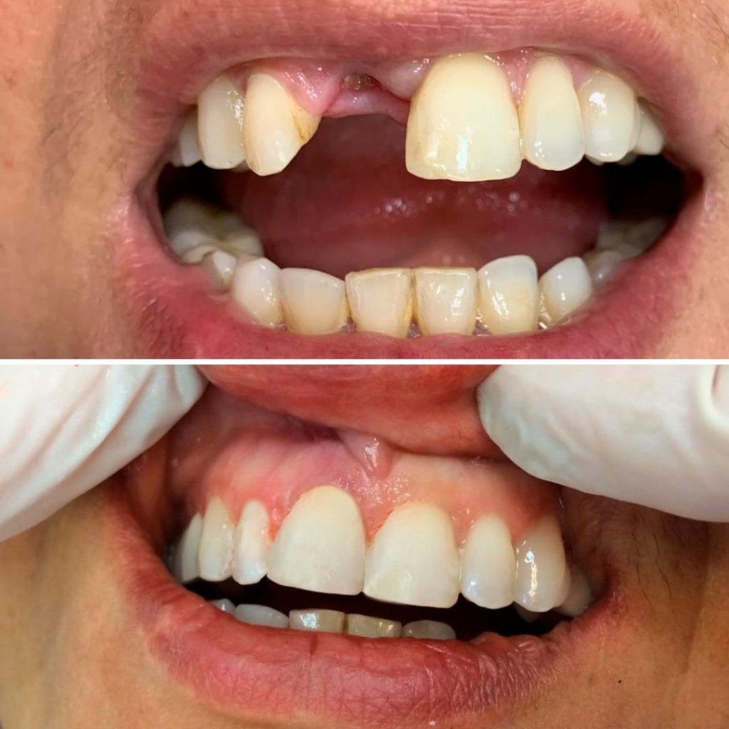 Resultado de cirurgia guiada para Tratamento com Carga Imediata.