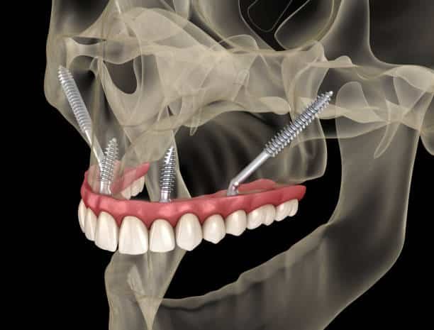 Radiografia lateral demonstrando a aplicação de Implantes Zigomáticos para suporte de prótese maxilar.
