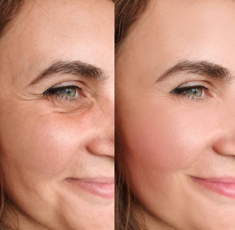 Resultado antes e depois de tratamento com Bioestimuladores faciais com colágeno.