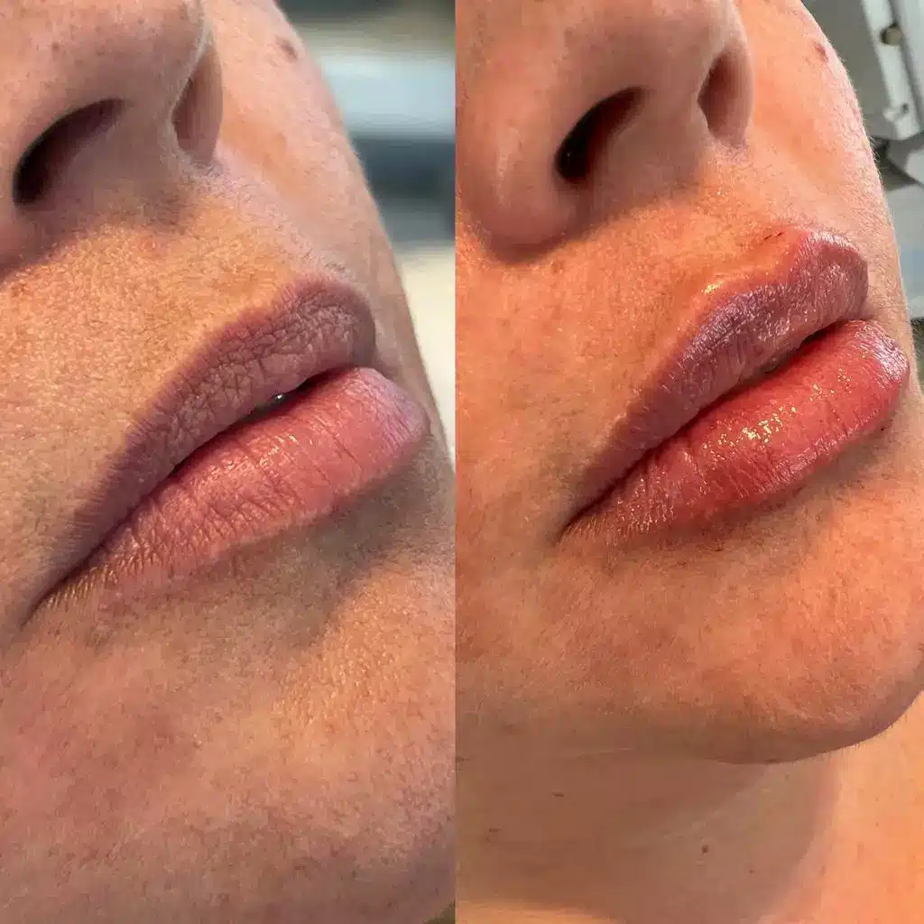 Antes e depois de Preenchimento Labial no Tatuapé na Allegra Odontologia, resultado sofisticado e natural.