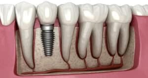Implantes Dentários em SP realizados na Allegra Odontologia com tecnologia de ponta