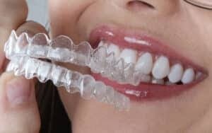 Paciente em atendimento odontológico para implantes, clareamento e Invisalign em SP – Allegra Odontologia.