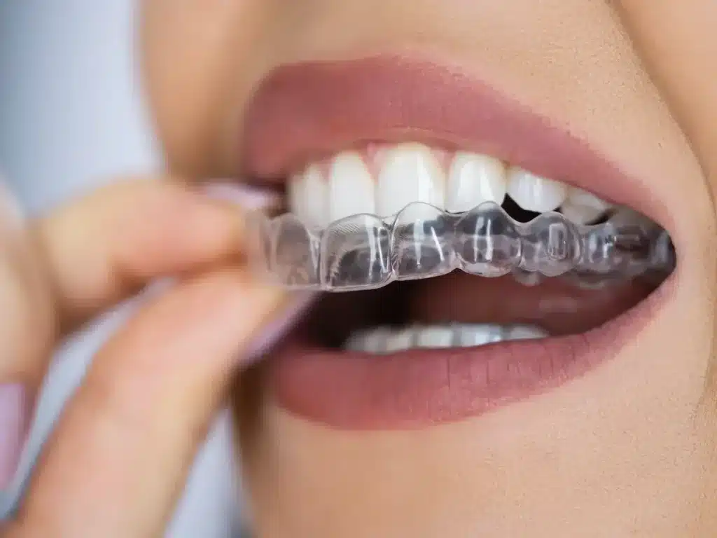 Invisalign em São Paulo com atendimento premium