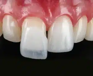 close da aplicação de lente de contato dental em São Paulo na Allegra Odontologia