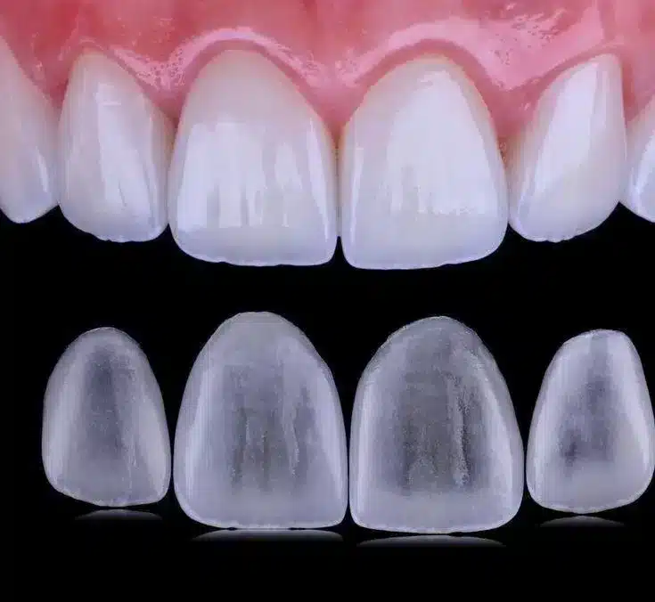 Antes e depois de aplicação de Lente de Contato Dental em 24 Horas na Allegra Odontologia, mostrando resultado estético de alto padrão.