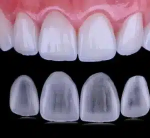 lentes de porcelana aplicadas em São Paulo pelo Dr. Rodolfo Segawa, especialista em odontologia estética