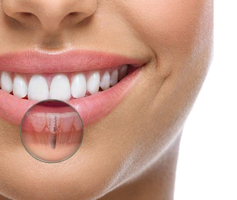 Close na arcada dentária com destaque para implante dentário, representando os benefícios do tratamento.