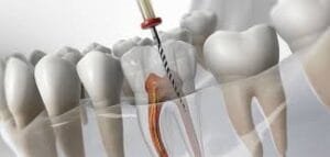 tratamento de canal no tatuapé com tecnologia de ponta e conforto