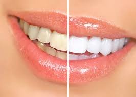 Clareamento dental São Paulo Allegra