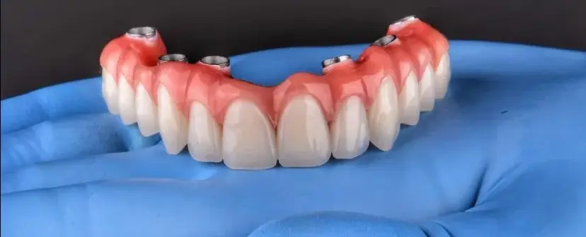 Implante dentário arcada total – tratamentos odontológicos São Paulo
