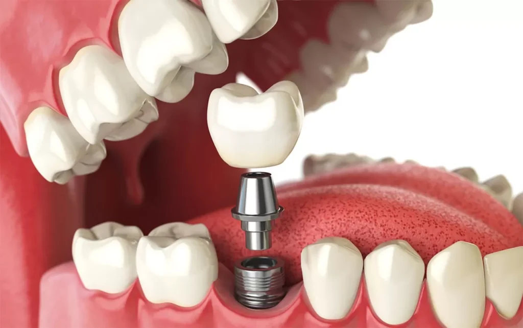 ilustração de implante dentário utilizado no tratamento de implantes dentários no Tatuapé pela Allegra Odontologia
