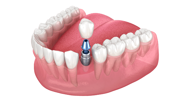 ilustração de implante dentário utilizado em tratamentos avançados de implantes dentários no Tatuapé
