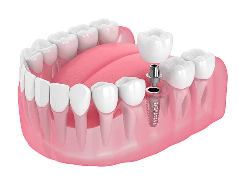 Modelo anatômico demonstrando implantes dentários em SP com foco na estrutura óssea