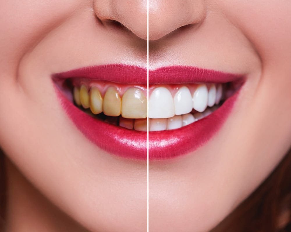 Sorriso realçado após clareamento dental em SP realizado na Allegra Odontologia.