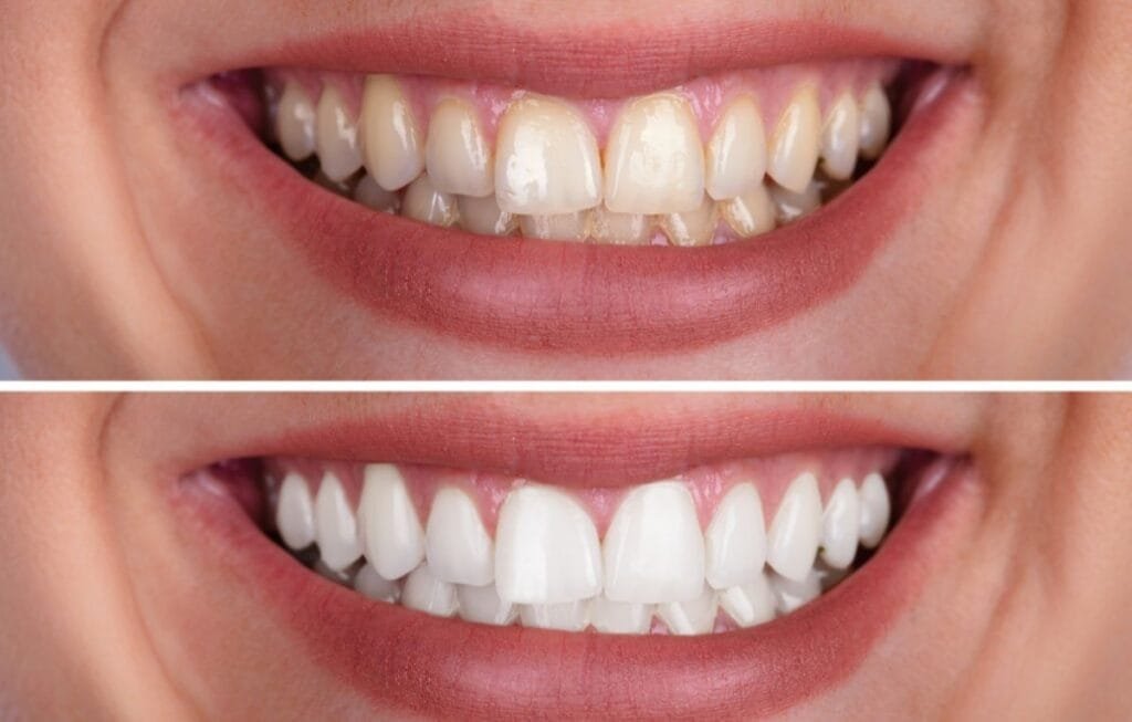Antes e depois de paciente que realizou tratamento com odontologia minimamente invasiva, destacando resultados naturais e estéticos.