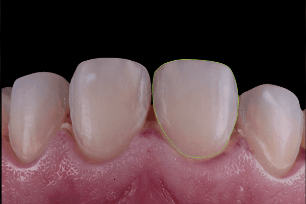 Close de dentes antes de procedimento com odontologia minimamente invasiva.