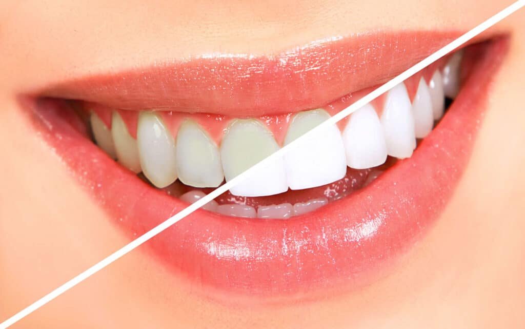 Resultado de Clareamento Dental em SP realizado na Allegra Odontologia