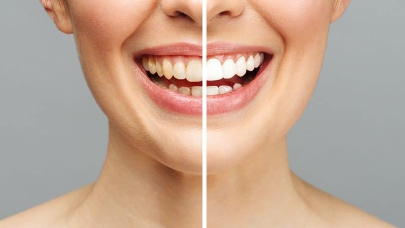 Resultado antes e depois do clareamento dental em SP feito na Allegra Odontologia.